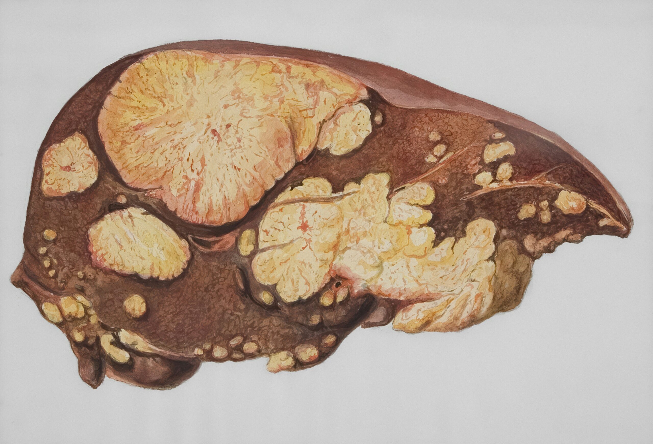 Metabolic Associated Steatotic Liver Disease